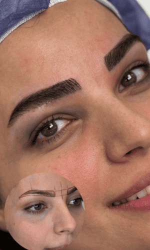 کاشت نچرال