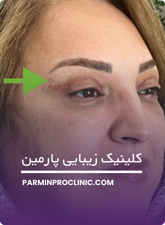 هزینه جراحی بلفاروپلاستی پلک بالا و پایین
